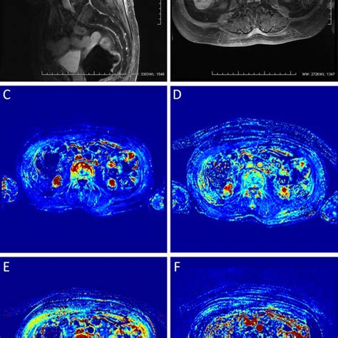 T1 Weighted Dynamic Contrast Enhanced Magnetic Resonance Imaging