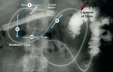 Finding the ligament of Treitz - Gastrointestinal Endoscopy