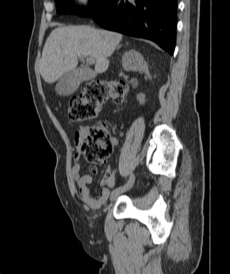 Radiopaedia Case Urinary Bladder Hernia Id Study Nc Commons