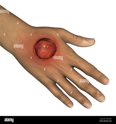 Buruli Ulcer On A Hand Illustration Stock Photo Alamy