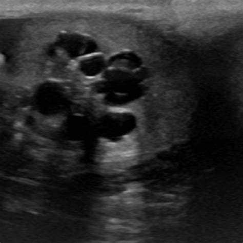 Ultrasound Of The Right Testicle Demonstrating A 2 4 X 2 1 X 2 2 Cm