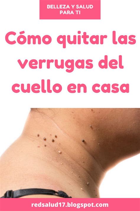 C Mo Quitar Las Verrugas Del Cuello En Casa En Como Quitar