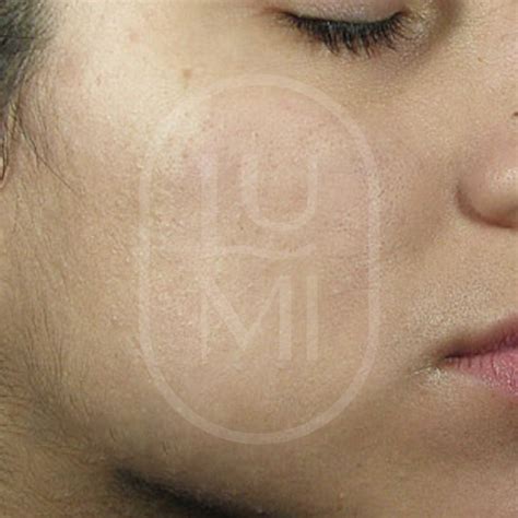 Acne Scar Treatment Sydney Acne Scar Removal