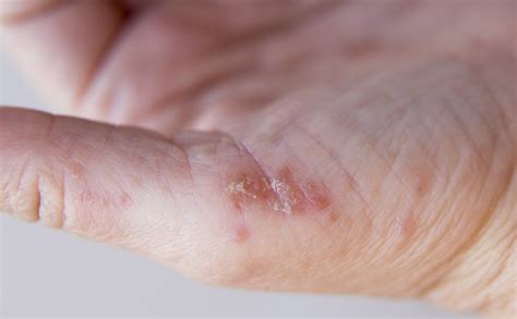 Psoriasis pustulosa qué debes saber Bekia Salud