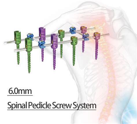 Breakable Polyaxial Pedical Screw Orthopedic Spine Implant Titanium