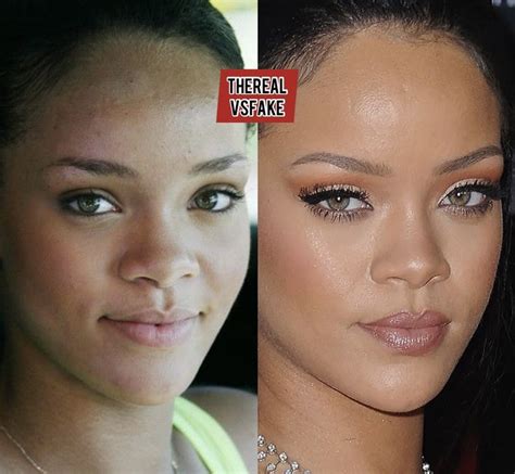 Rihanna Before And After Nose Fillers No Contour Nose Fillers