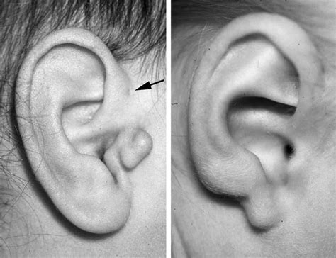 Left An Auricular Malformation With A Preauricular Sinus Arrow And