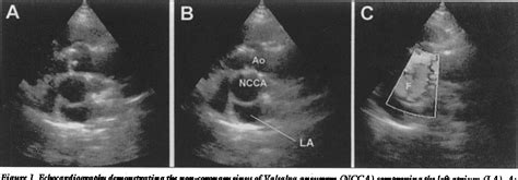 Figure 1 From Imaging Of A Non Coronary Sinus Of Valsalva Aneurysm With