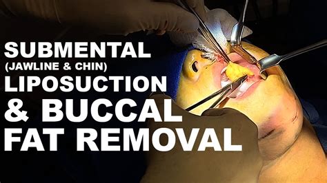 Submental Liposuction And Buccal Fat Removal Dr Paul Ruff West End Plastic Surgery Youtube