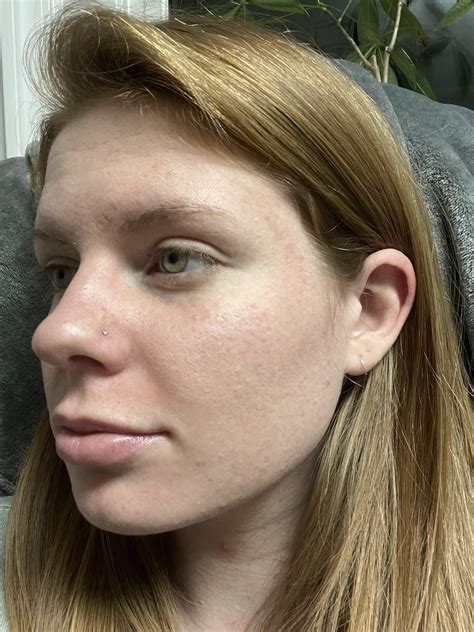 Update 4 Days Post Microneedling Most Of The Dry Skin Has Fallen Off My Skin Broke Out More