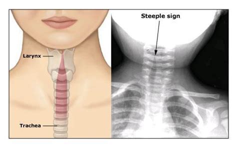 Croup County Em