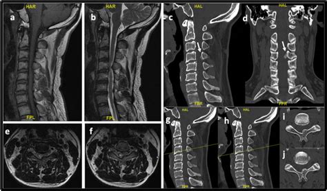 Unilateral Biportal Endoscopic Supralaminar Posterior Spinous Process