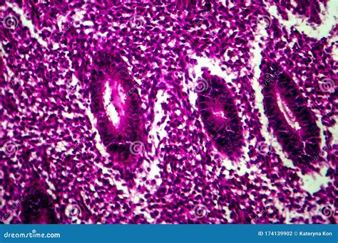 Endometrial Hyperplasia Light Micrograph Stock Photo Image Of