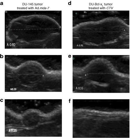 B Mode Ultrasound US Imaging Of DU 145 Tumor Xenografts Treated With