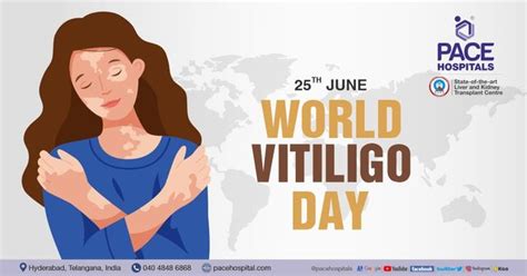 World Vitiligo Day 2024 Theme Zarla Kathryne