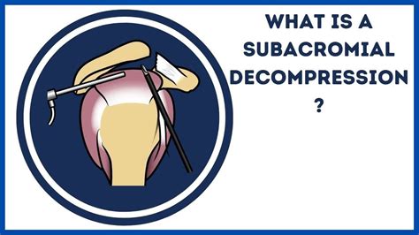 What Is A Subacromial Decompression Youtube