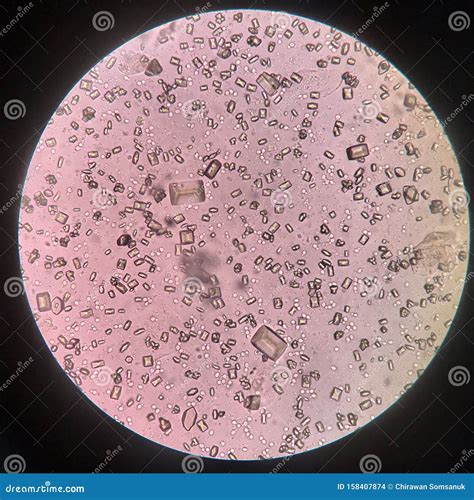 Urine Analysis Finding With Microscope Show Crystal Bacteria And