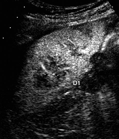 Differentiation Of Benign From Malignant Focal Splenic Lesions Using Sulfur Hexafluoridefilled