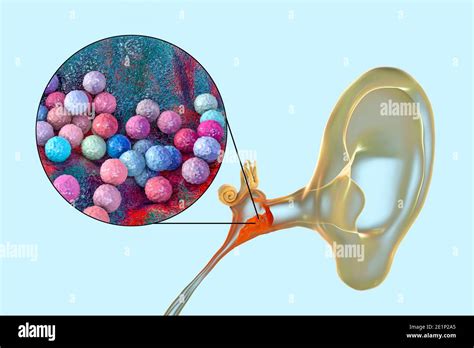 Otitis media infección del oído ilustración Fotografía de stock Alamy