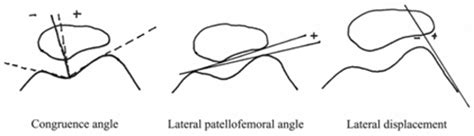 Patellofemoral Joint Knee And Sports Orthobullets