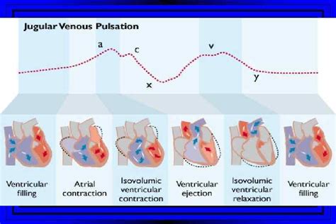 Right Heart Catheterization Swan Ganz Catheter Swan Ganz Catheter