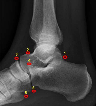 Accessory ossicles of the foot | Radiology Case | Radiopaedia.org | Accessories, Feet, Radiology