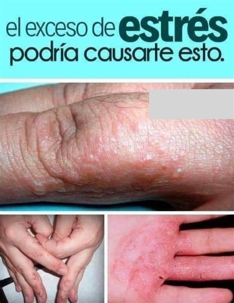 Estrés Síntomas Y Cómo Controlarlo Bien De Salud