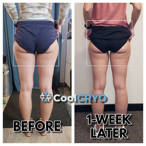 Coolcryo Reduce Fat Fix Cellulite Tighten Skin Rapid City