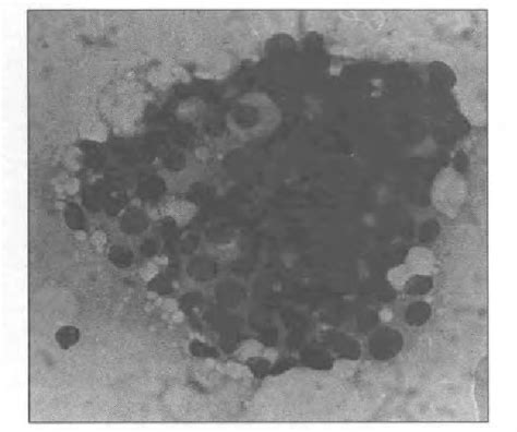 Figure 1 From Four Quadrant Fine Needle Aspiration Cytology Of Non Palpable Benign Proliferative