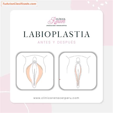 Labioplastia Salud Y Belleza Cuidado De La Salud