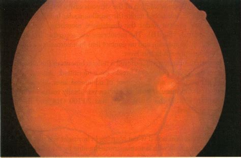 Figure 1 From The Etiology And Treatment Of Macular Detachment