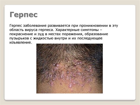 Заболевания кожи головы - online presentation