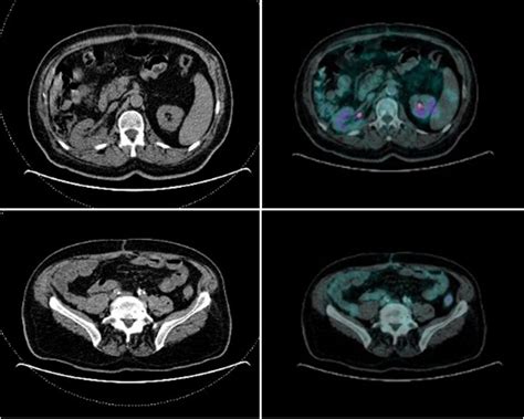 Figure 2 From Recurrent Giant Retroperitoneal Liposarcoma With 10 Years