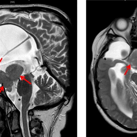 Pattern Of A Large Hypothalamic Hamartoma In An Years Old Female