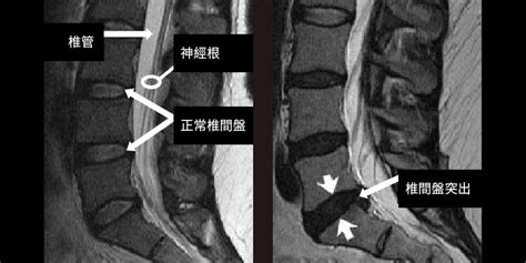 下背痛、坐骨神經痛當心退化提前上門，脊椎狹窄症的治療與預防 維力骨科診所