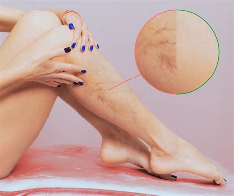 Spider Veins Causes And Effective Treatment Options Dr Ahmed Farah Abdulrahman