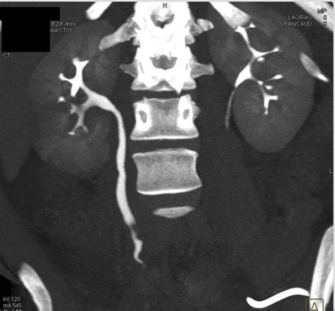 Acute Pyelonephritis Right Kidney With Blood Clots In The Ureter