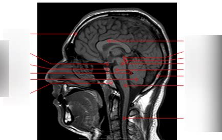 Diagram Radiologie Anatomie Hersenen Quizlet