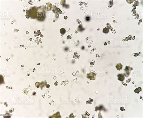 Uric Acid Crystal Calcium Oxalate Dihydrate In Urine Sediment Stock