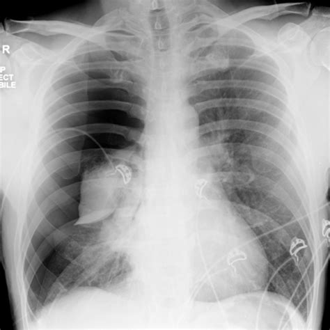 Clinical Supplement Thorax Flashcards Quizlet