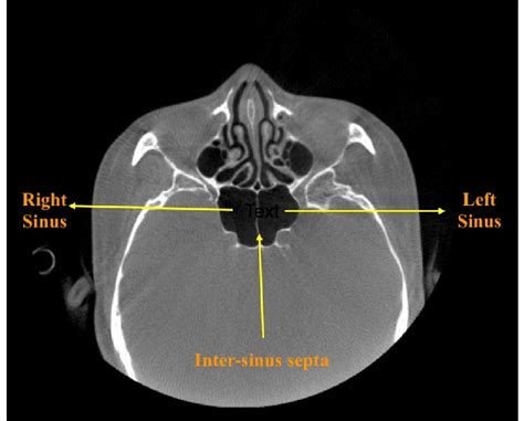 Representative Image Depicting Inter Sinus Septum And The Left And