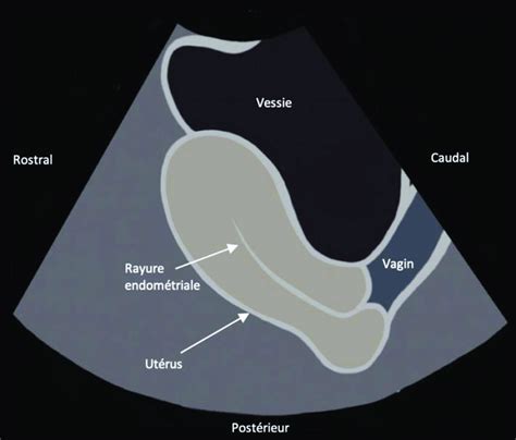 Schéma échographique de l utérus en axe long Il est important de