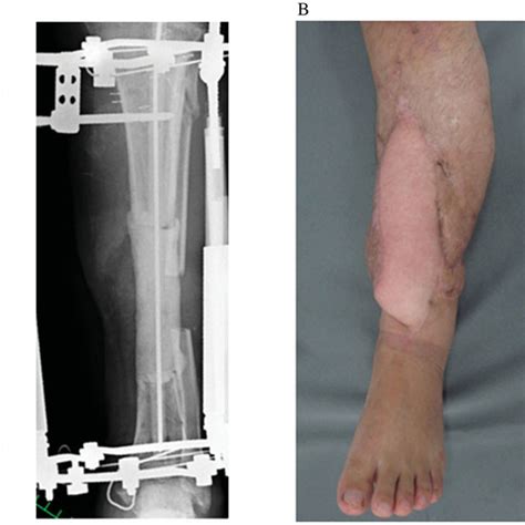 Case 1 A Preoperative Clinical And Radiographic Findings B