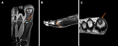 Metatarsal Head