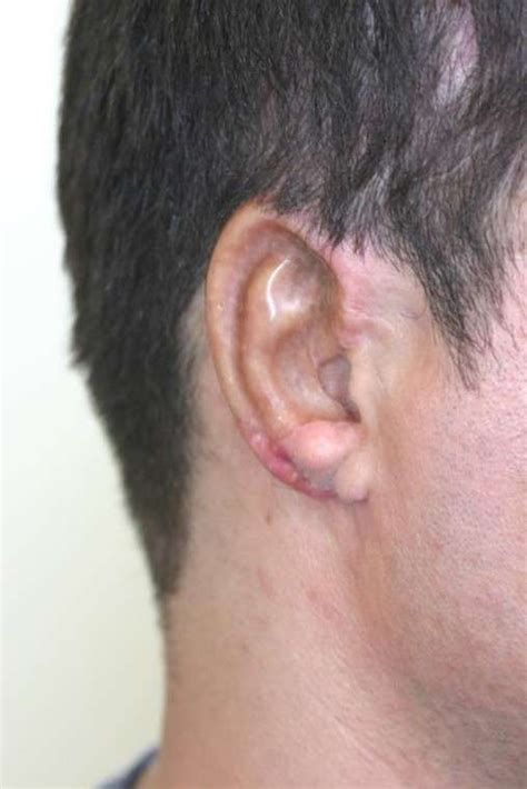 Otoplasty Pinnaplasty Ear Lobe Surgery Non Surgical Ear Pinning