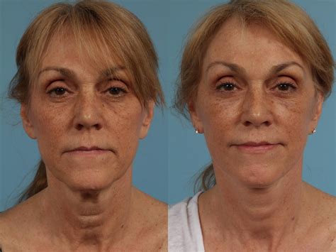 Facelift Before And After Photos Prove Just How Natural Todays Results Look Tlkm Plastic Surgery