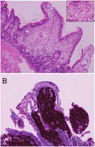 Detection Of Whipple S Disease A Duodenal Mucosa Showing Loss Of