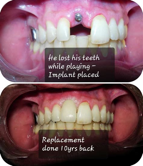 IMPLANT VS BRIDGE