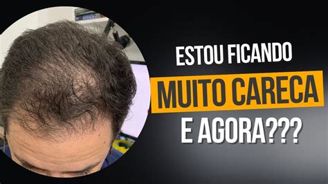 Minoxidil E Finasterida Da Manual Cansei De Estar Ficando Careca