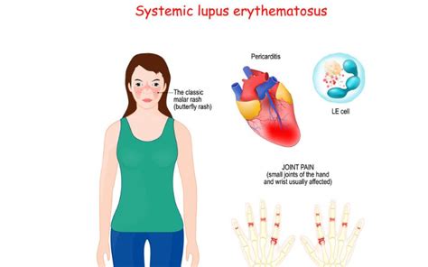 Lupus And Its Four Types Explained